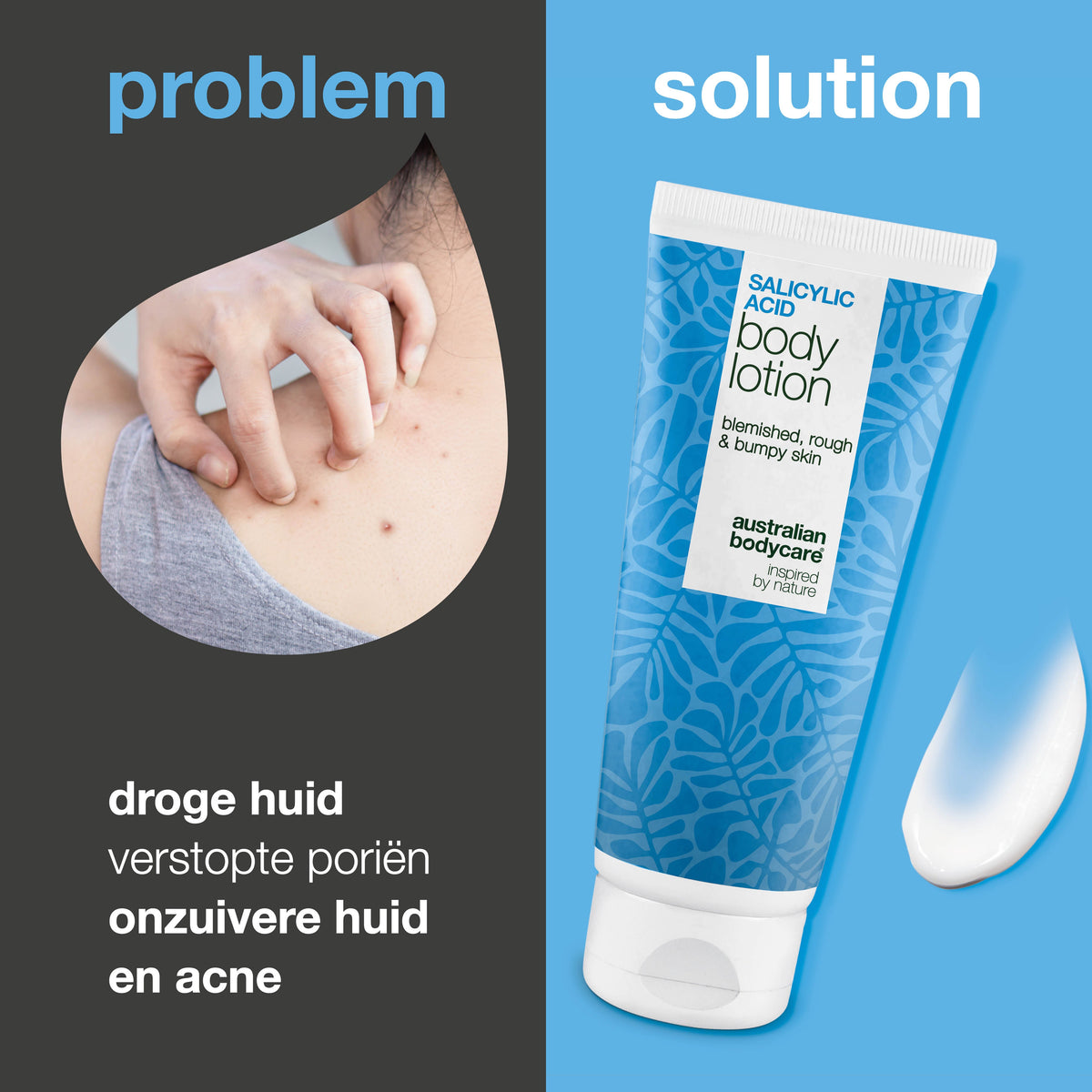 Body Lotion met salicylzuur – tegen onzuiverheden en droge huid — Body Lotion met salicylzuur exfolieert, hydrateert en helpt bij onzuiverheden, ruwe en droge huid. Perfect voor dagelijks gebruik.