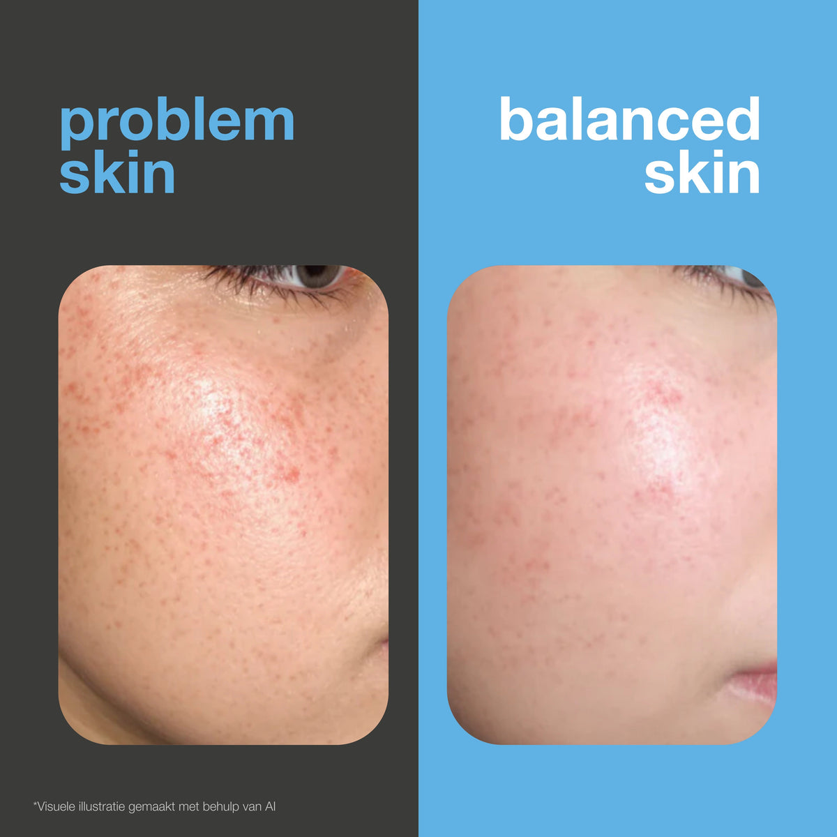 Salicylzuur serum voor mee-eters, vette huid en verstopte poriën — Salicylzuur serum bij vette huid, mee-eters en poriën. Met Zinc PCA, groene thee, hyaluronzuur en hydraterende glycerine.