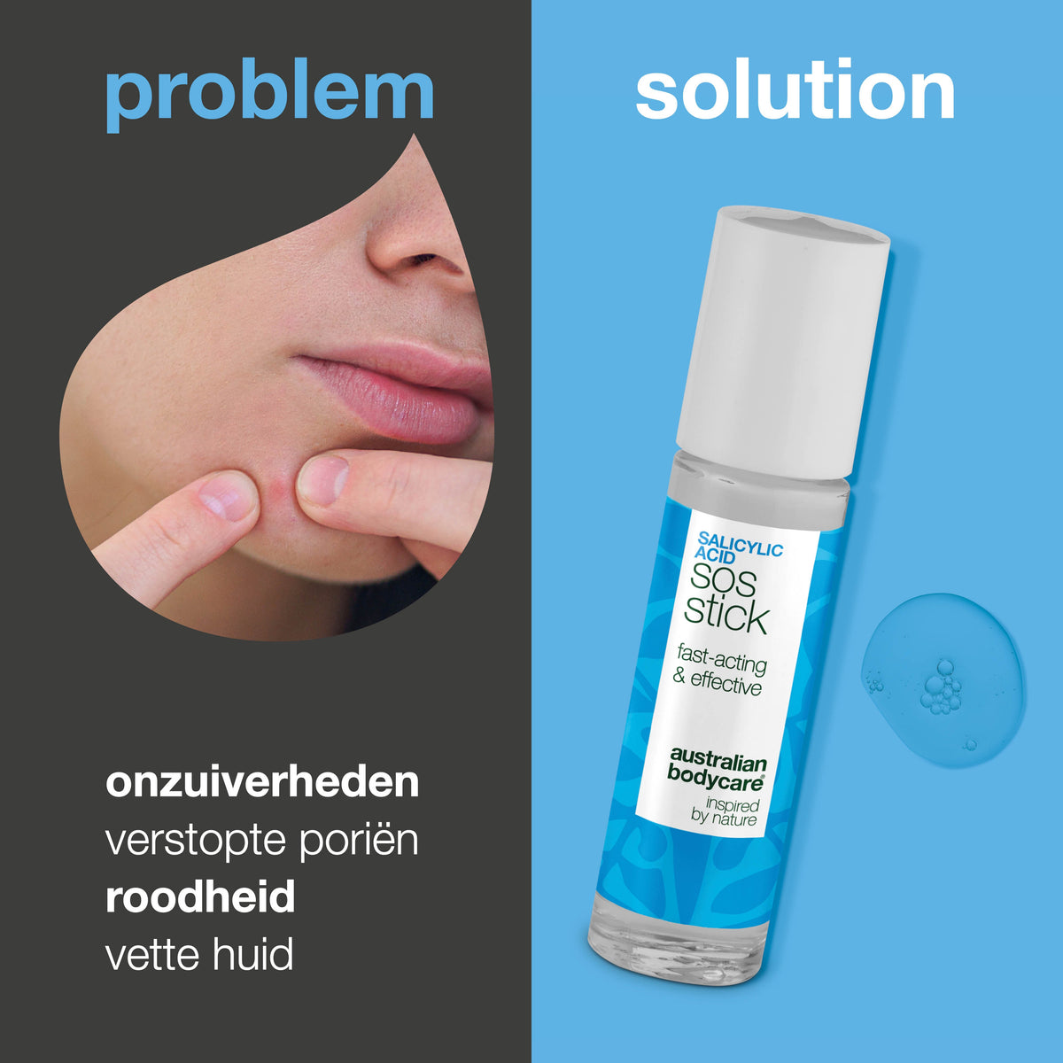 Salicylzuur SOS Stick tegen puistjes en verstopte poriën — Salicylzuur SOS Stick zuivert een vette, onzuivere huid. Helpt roodheid verminderen en huidbalans herstellen. Met Salicylzuur.